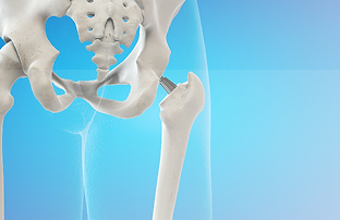 Total Hip Replacement