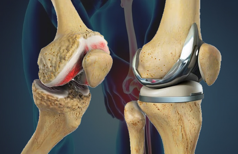 Total Knee Replacement