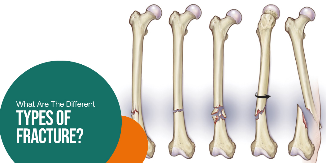What Causes Knee Pain in Females?