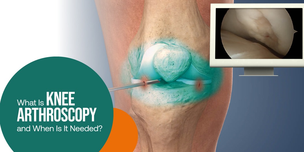 Knee Arthroscopy