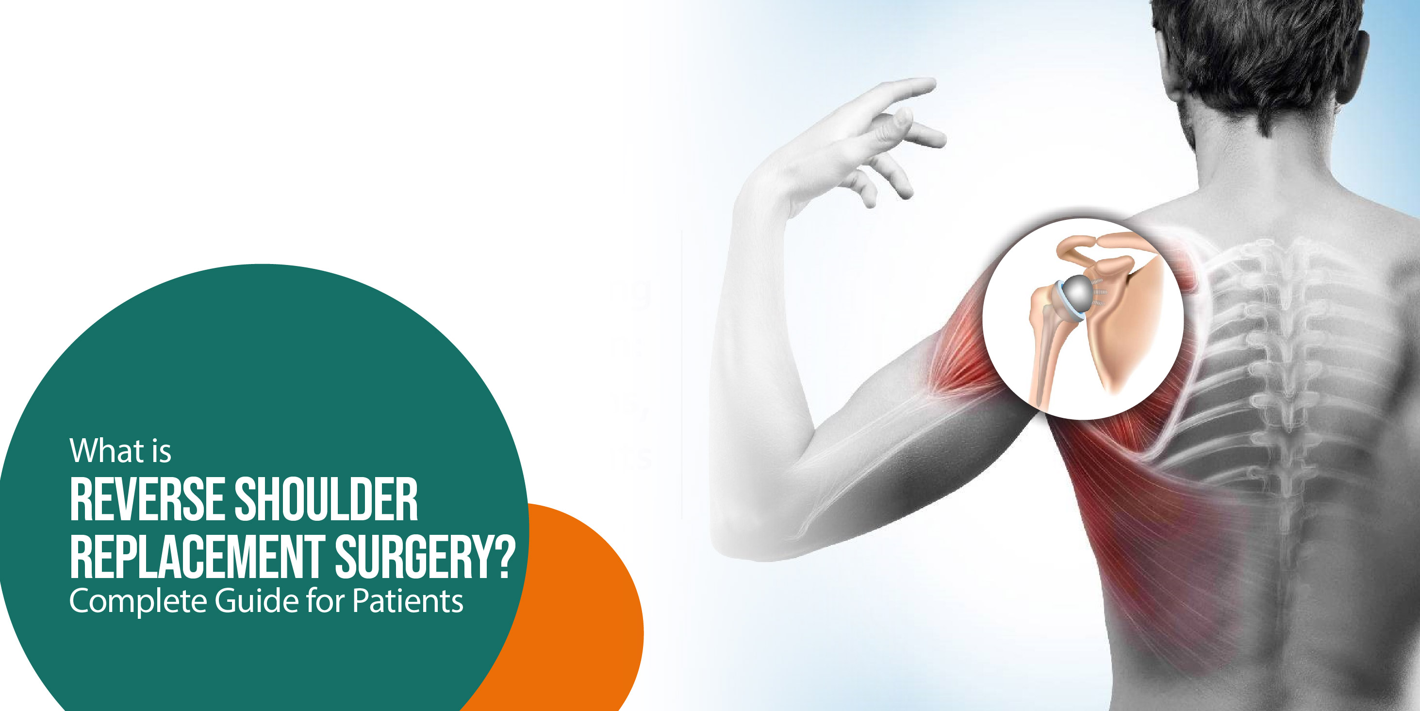 Reverse Shoulder Replacement Surgery